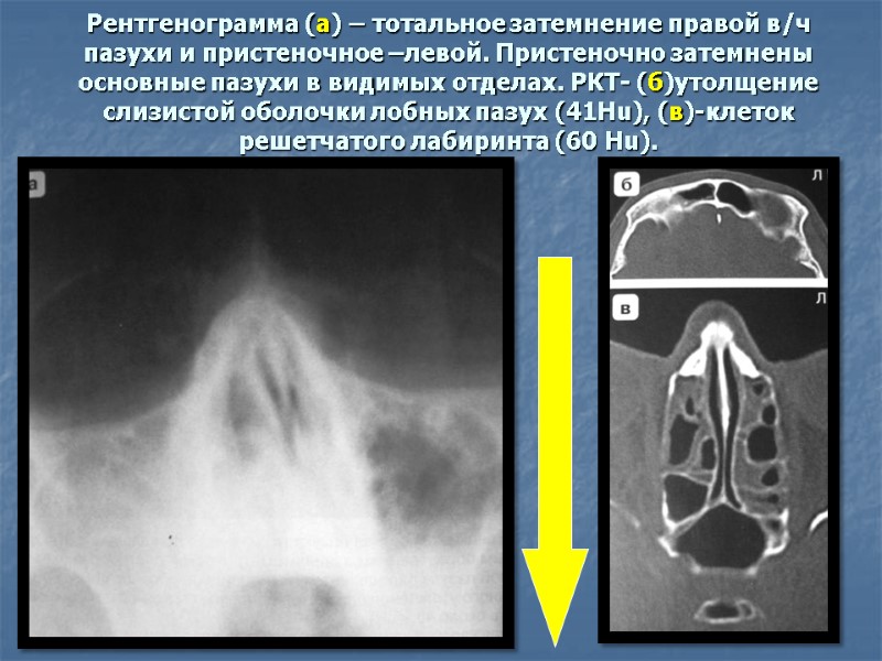 Рентгенограмма (а) – тотальное затемнение правой в/ч пазухи и пристеночное –левой. Пристеночно затемнены основные